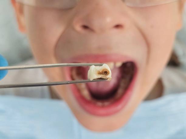 Best Dentist for Tooth Abscess  in Riverton, IL